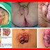 OBAT ALAMI SAKIT BAB BERDARAH thumbnail