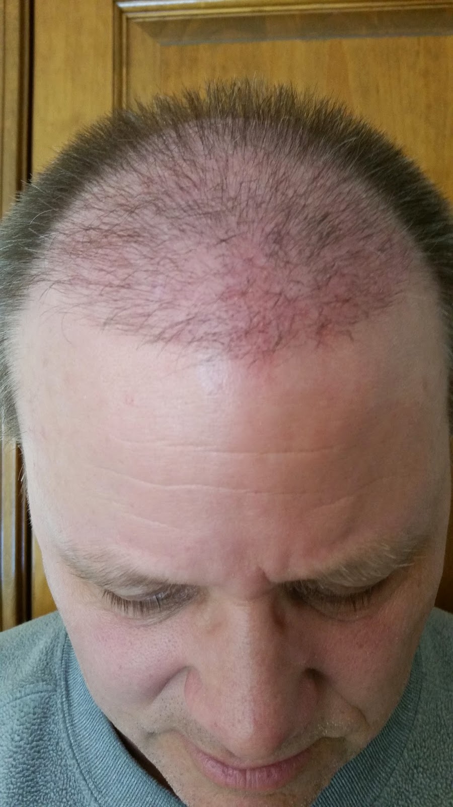 My FUE Hair Transplant 45 Days After My 2nd FUE Hair Transplant My FUE Hair Transplant 45 Days After My 2nd FUE Hair Transplant