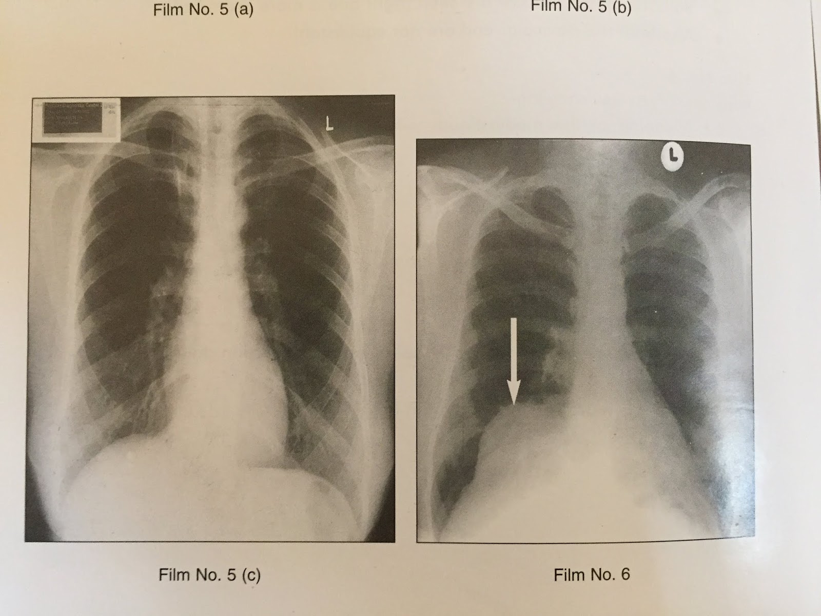 NORMAL VARIANT OF CHEST XRAY