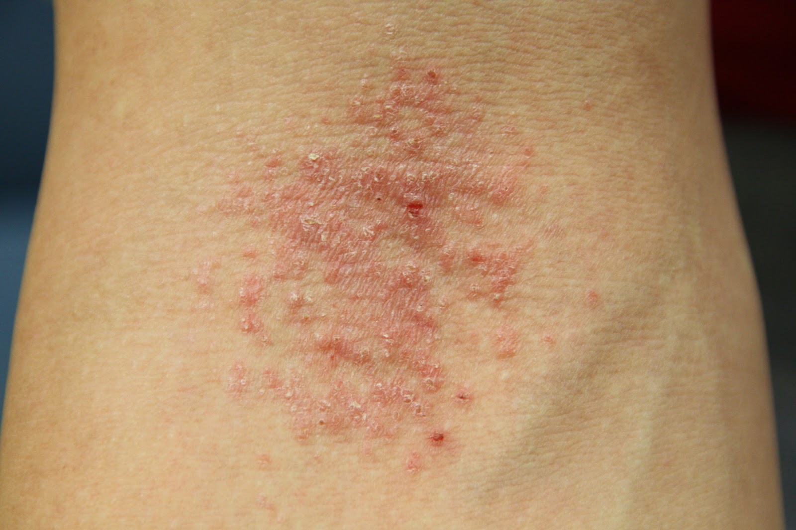 Reshapelife Eczema The Itch That Keeps On Itching