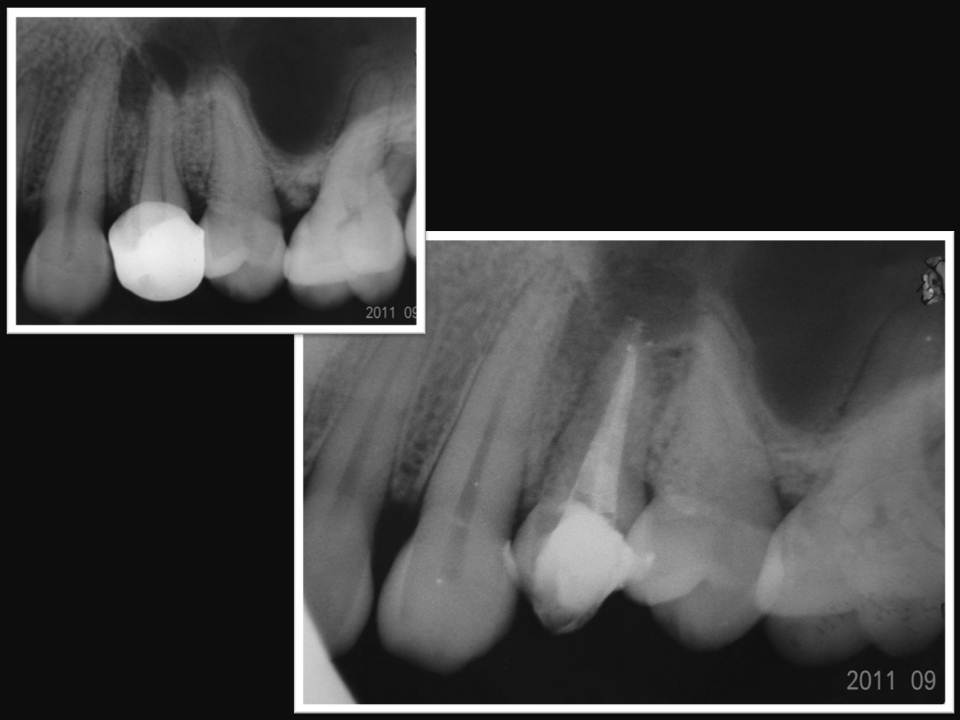 ENDODONCIA Casos Clínicos CALAMUS DUAL + CASO CLINICO