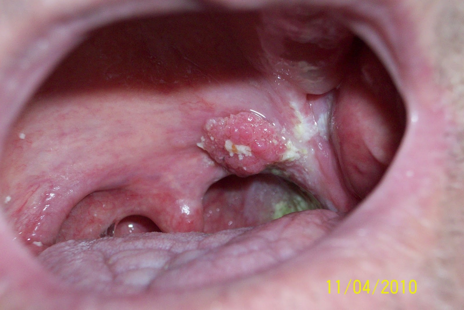 Benign neoplasm larynx papillomatosis. Papiloma em palato mole