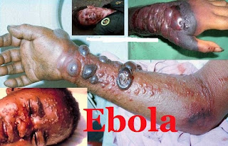 Image result for penyakit ebola