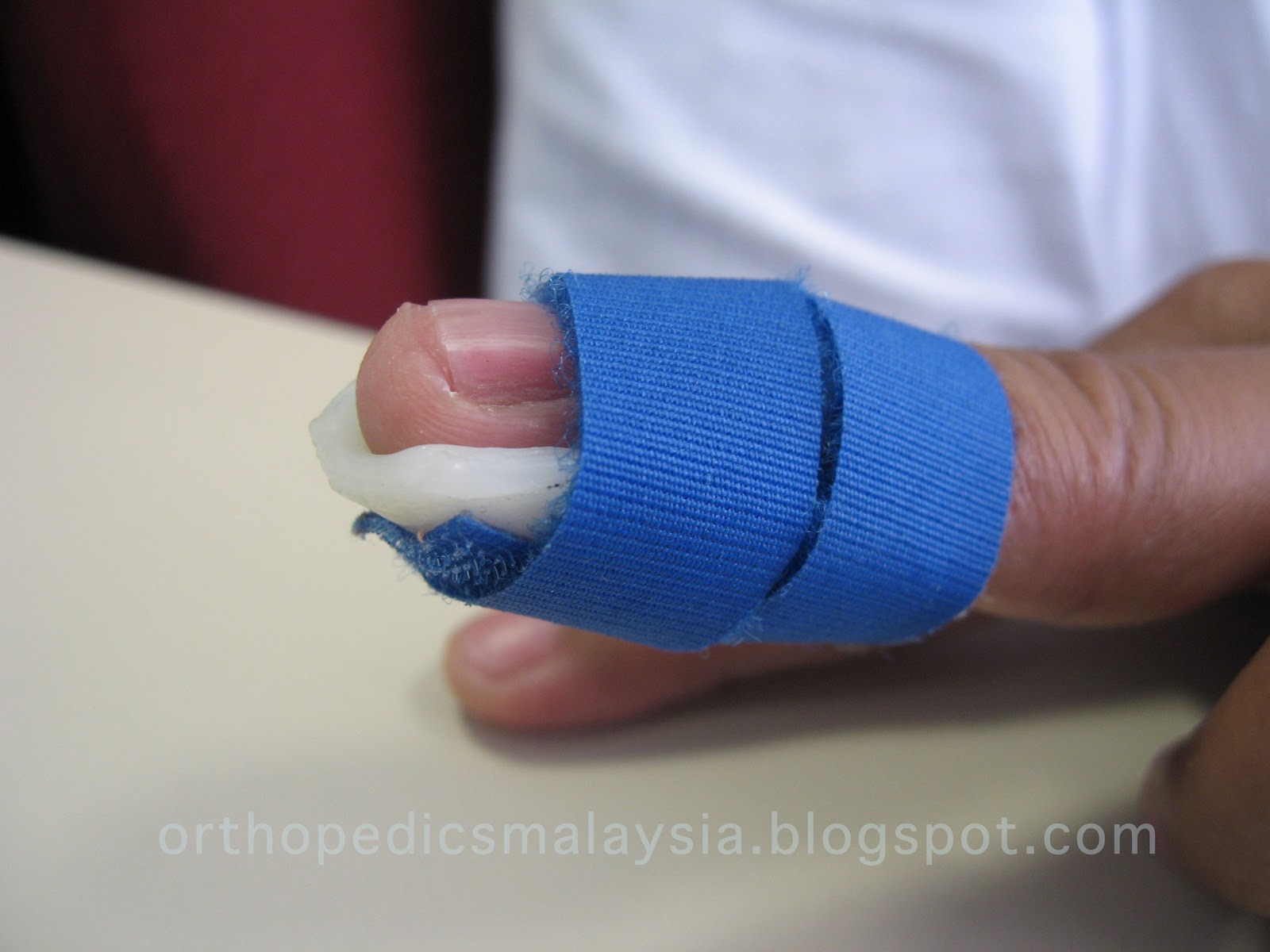 STACK THEM UP The Mallet finger splint The Orthopedics Malaysia blog