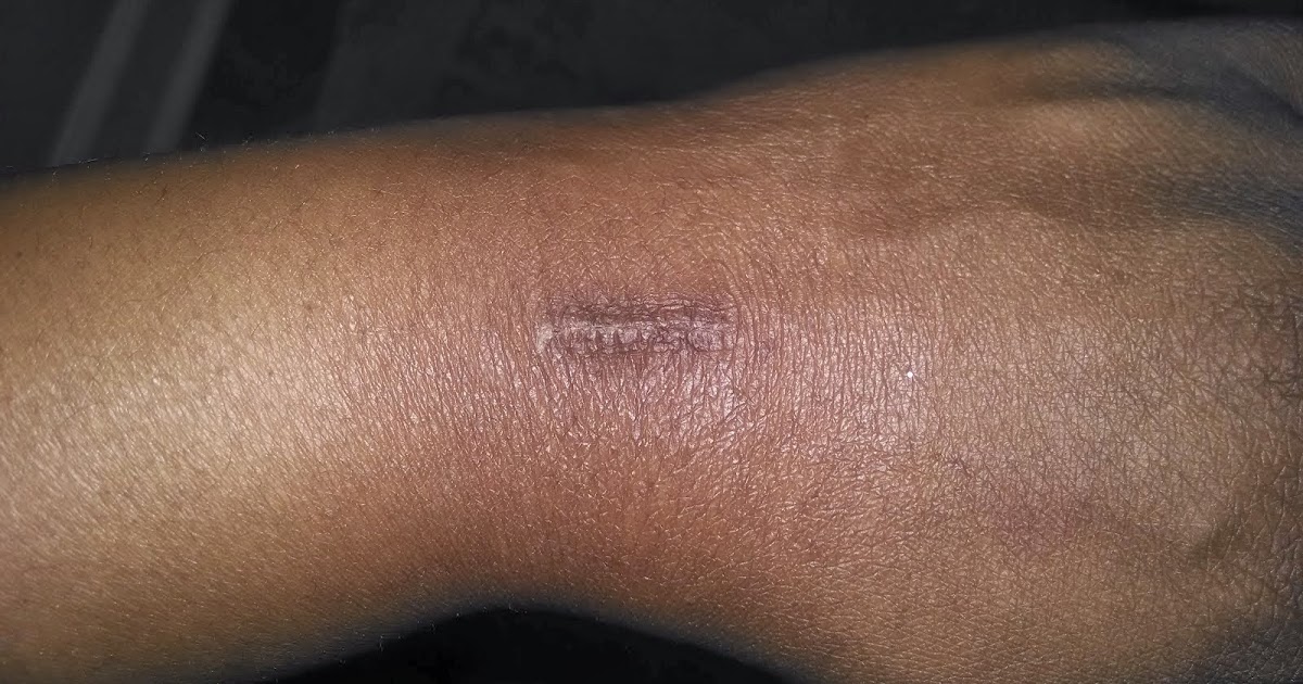 Mobi·gas·mic 25 Days Post Surgery Ganglion Cyst Scar
