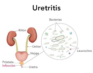 Uretritis