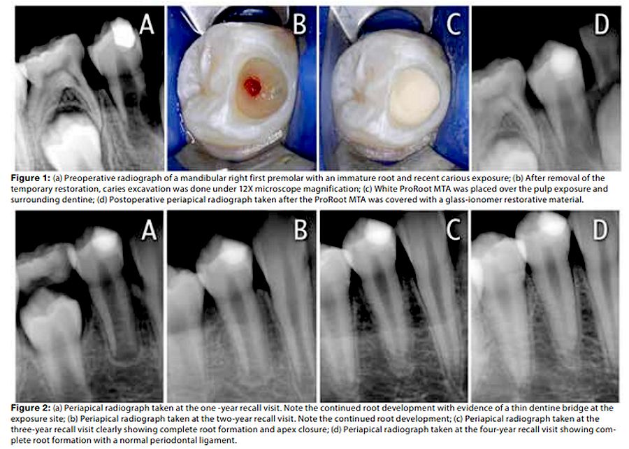 PDF Apexogenesis treatment with mineral trioxide aggregate longterm