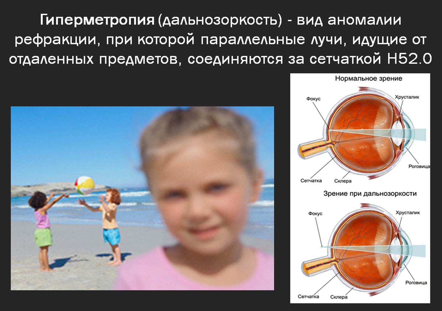 Слабая миопия глаза что. Гиперметропия слабой степени ou у детей. Глаз гиперметропия высокой степени. Дальнозоркость слабой степени. Осложнения гиперметропии.