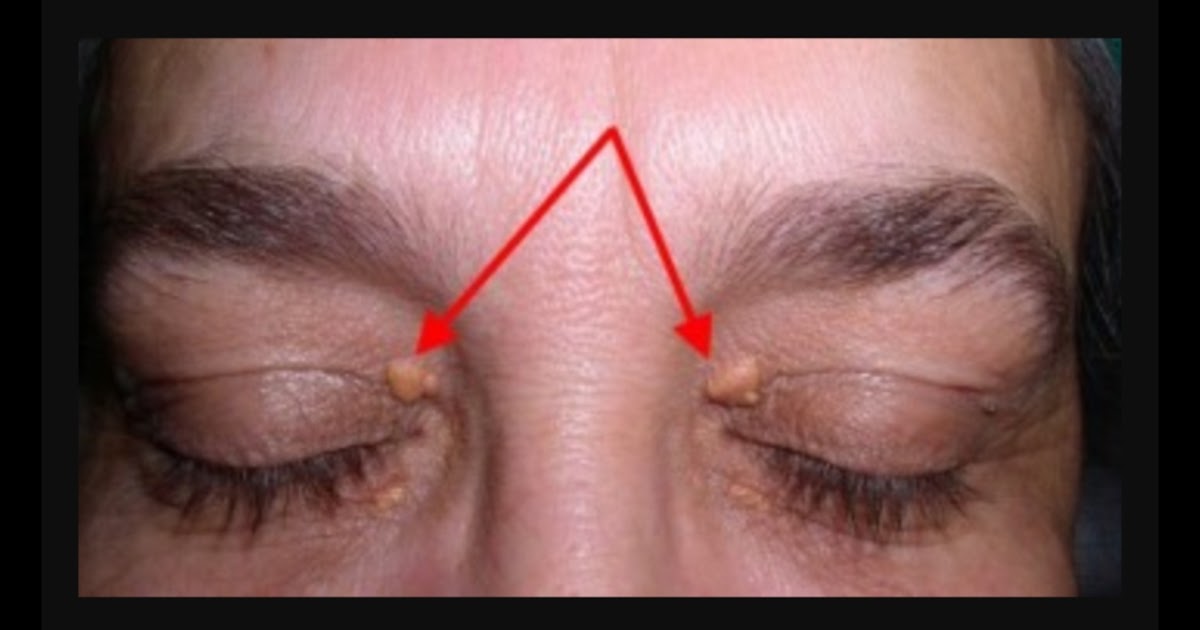 Rimedi Naturali Depositi Di Colesterolo Perche Si Formano E Come Eliminarli In Modo Naturale