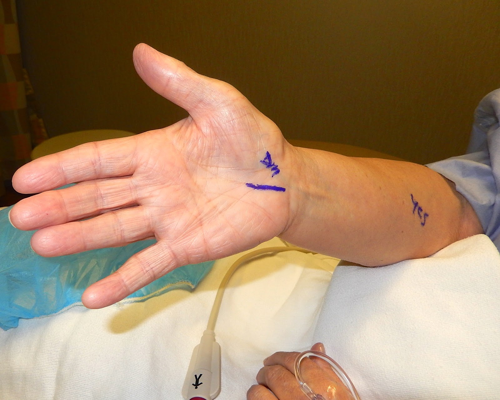 Rolfsrud Friends &amp; Family Carpal tunnel surgery over in a twinkle, all