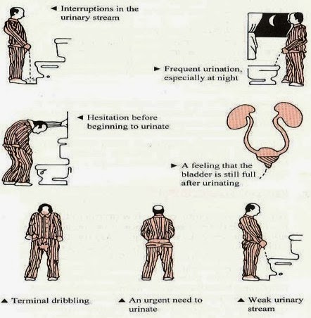 Hel homeopátia prostatitis