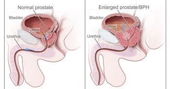 Eyaculación retenida prostatitis