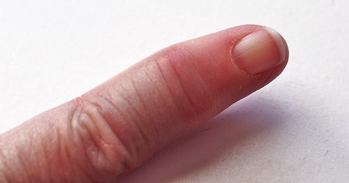 reasonably-well-psoriatic-arthritis