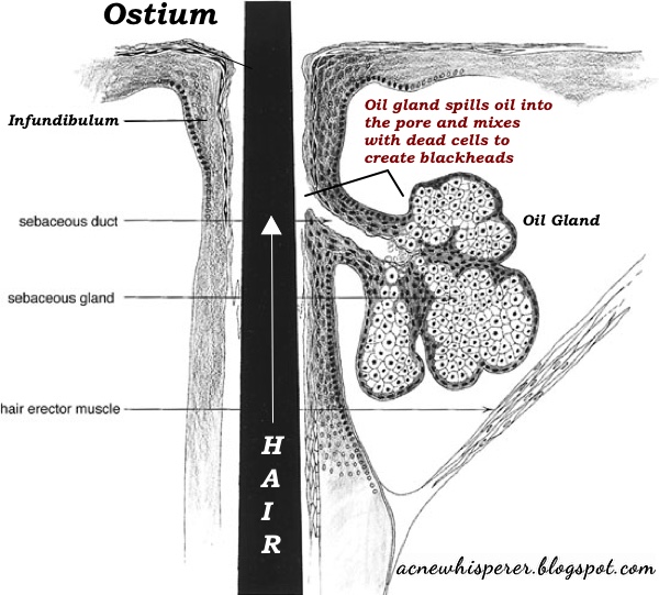 Graphic of hair follicle showing the oil gland and how blackheads form