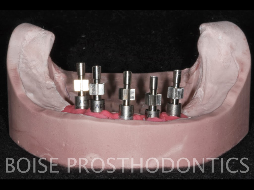 Boise Idaho Prosthodontics Verification Jig Fabrication for Mandibular Hybrid Prosthesis
