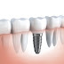 Giá cấy ghép răng implant bao nhiêu tiền là hợp lý ?