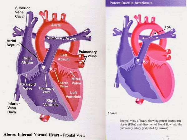 My Rendezvous: Patent Ductus Arteriosus
