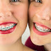 Nên chăm sóc răng miệng cho trẻ sau niềng răng như thế nào?