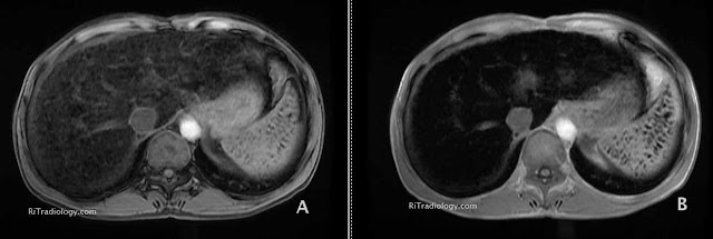 RiT radiology: Hemochromatosis