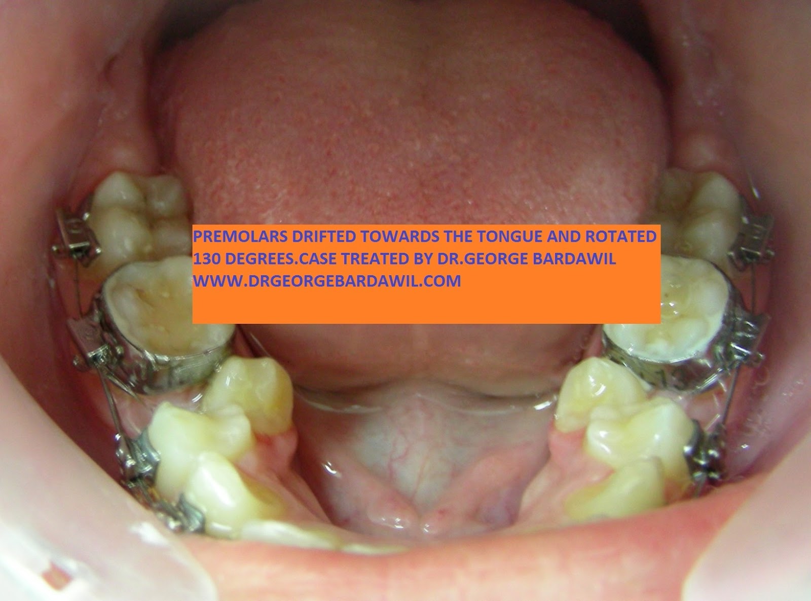 E. BardawilOrthodontistInvisalign Diamond level Rotated