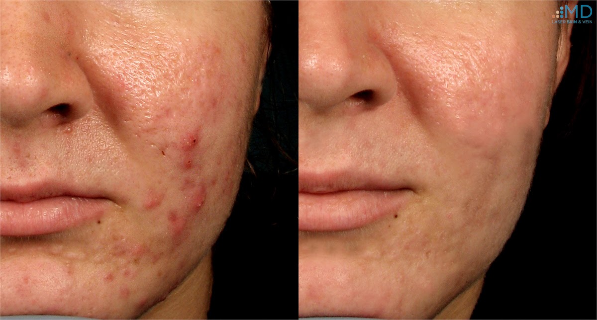 How to Treat Open Pores in 20 Days - Home Remedy - B & G ...