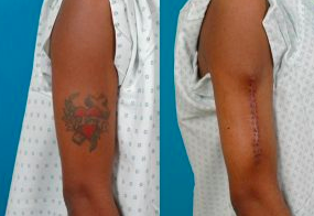 Tatt Chat: Surgical excision as a tattoo removal technique and the risks of  scarring