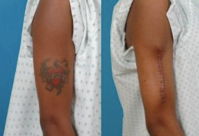 Tattoo Removal Cost  Thoughtful Tattoos