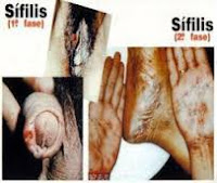 Paling Ampuh Obat Sembuhkan Penis Terkena Sipilis Paling Ampuh Obat Sembuhkan Penis Terkena Sipilis
