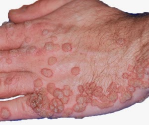 Warts Pictures - Verywell