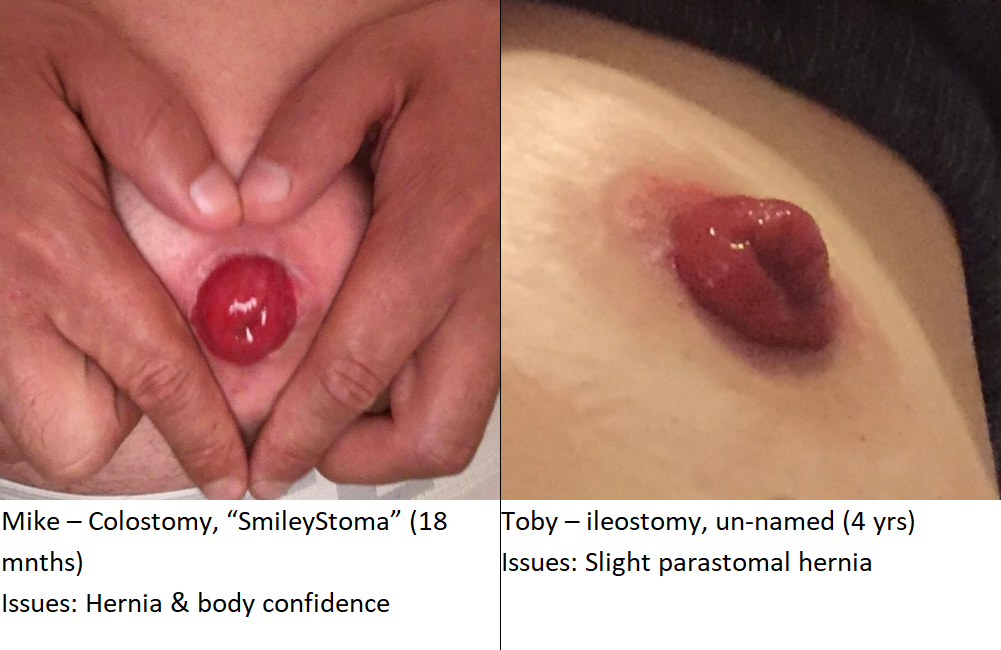 Stoma gallery.
