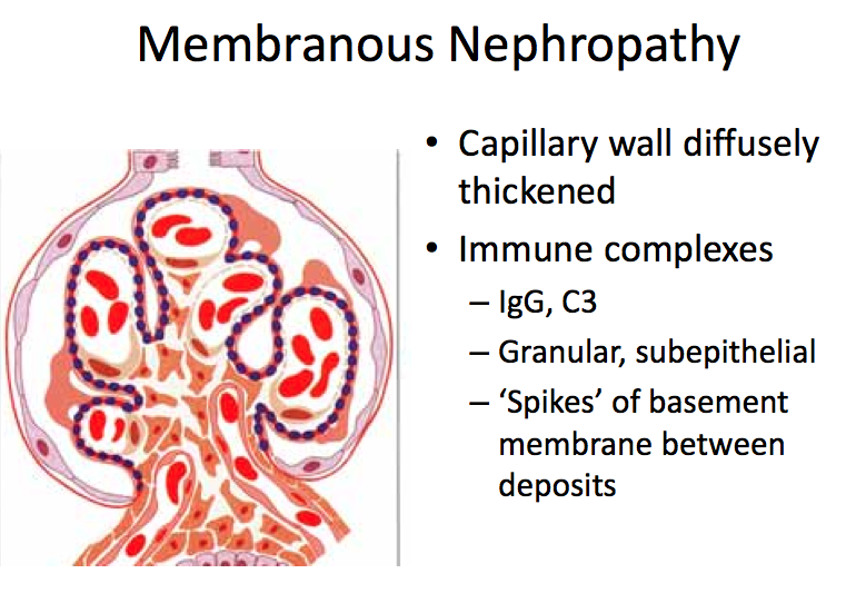 Glomerulonephritis Membranous Heymann Nephritis Membranous