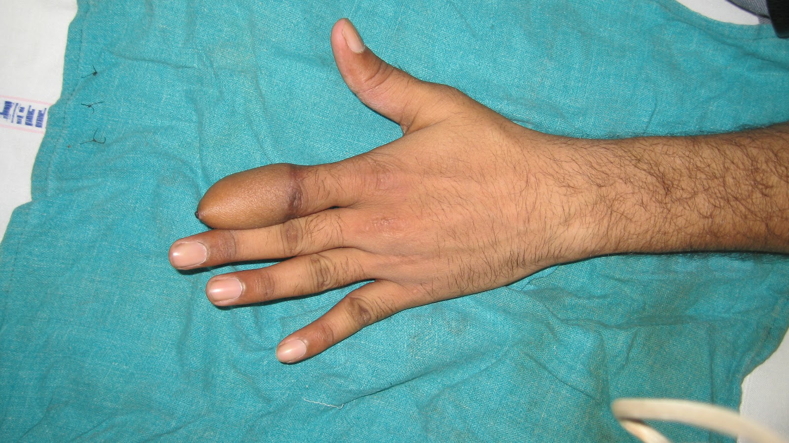Ring Avulsion 2021 : Closed Ring Avulsion Injury With Isolated Arterial ...