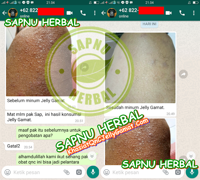 Obat Herpes Di Leher Tradisional Terampuh & TERBUKTI MANJUR!! Obat Herpes Di Leher Tradisional Terampuh & TERBUKTI MANJUR!!