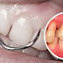 Periodontite é coisa muito séria e você pode perder todos os seus dentes!