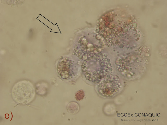 Gotas De Grasa En Sedimento Urinario uroanalisisconaquic.blogspot.com