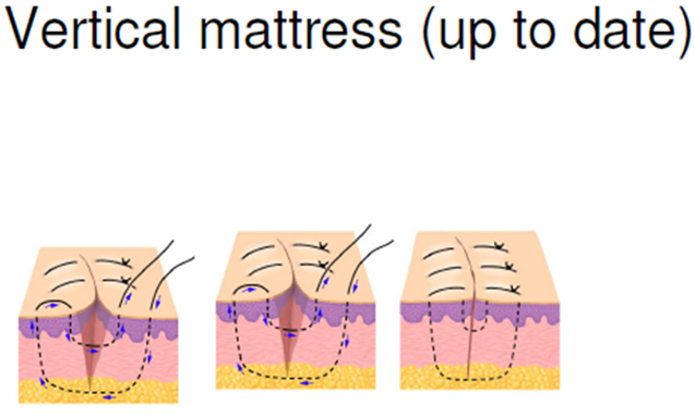 horizontal mattress suture