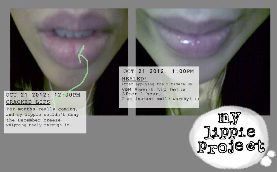 V&M NATURALS TRUE CONFESSION CRACKED BLEEDING LIPS HEALED IN AN HOUR!