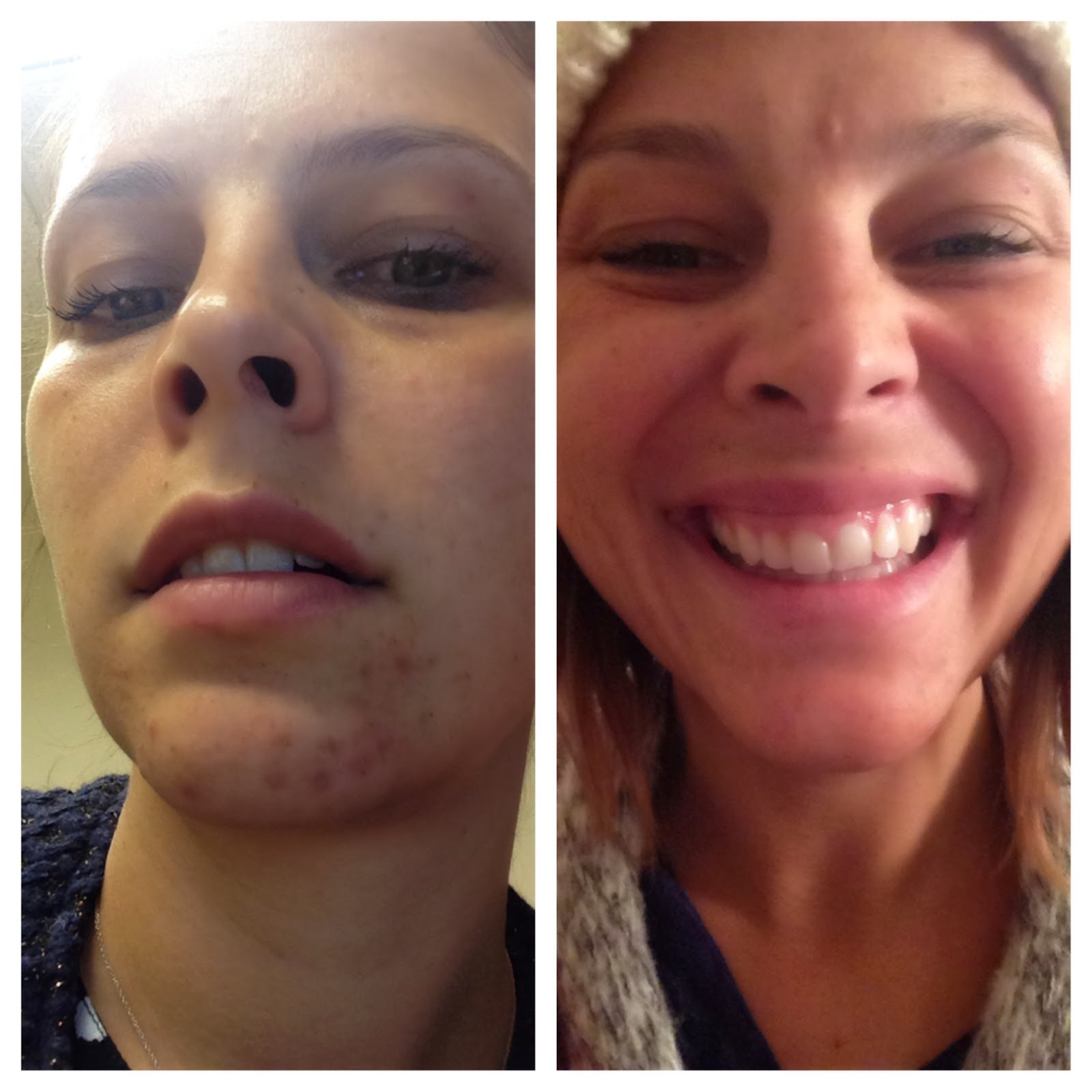 Start Close In Styling Dairy and Acne What Has Worked For Me