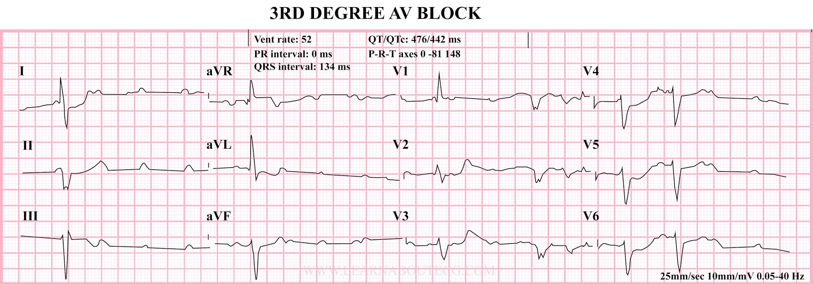 3rd Degree AV Block EKG Strip