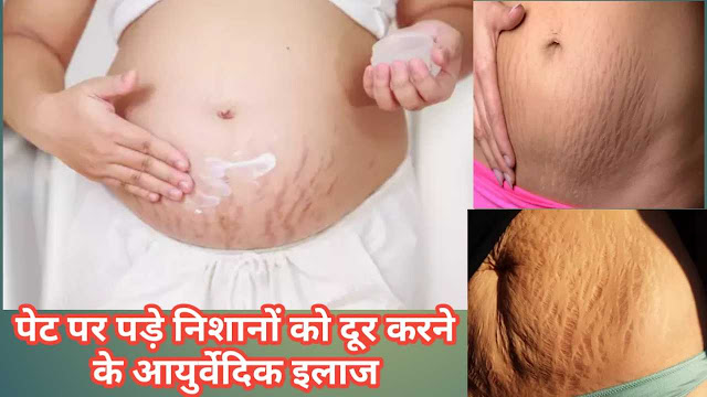 बच्चे के जन्म के बाद पेट पर पड़े निशानों को दूर करने के आयुर्वेदिक इलाज बच्चे के जन्म के बाद पेट पर पड़े निशानों को दूर करने के आयुर्वेदिक इलाज
