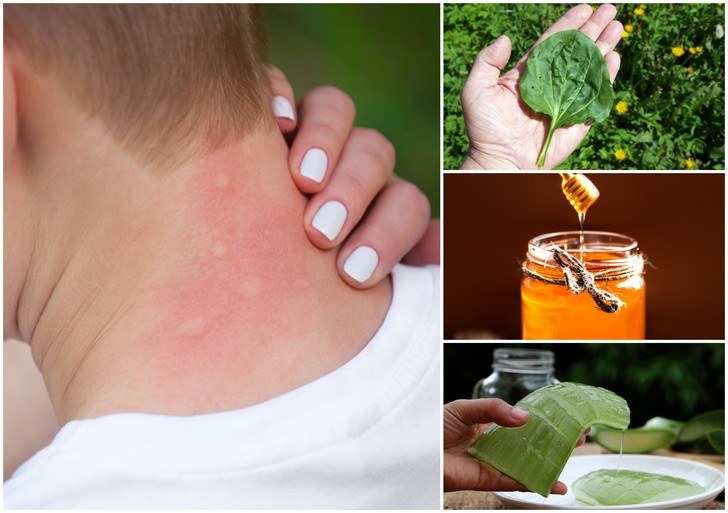 Home Remedy For Mosquito Bite Relief