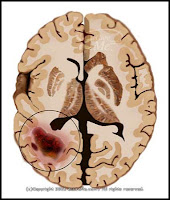 brain tumor and cancer