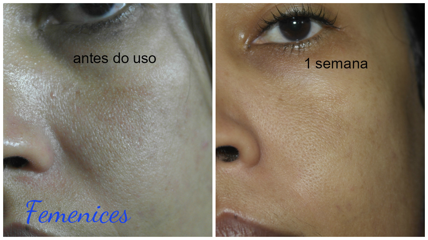 Resenha: Redemic R e Effaclar Anti-idade (La Roche- Posay)