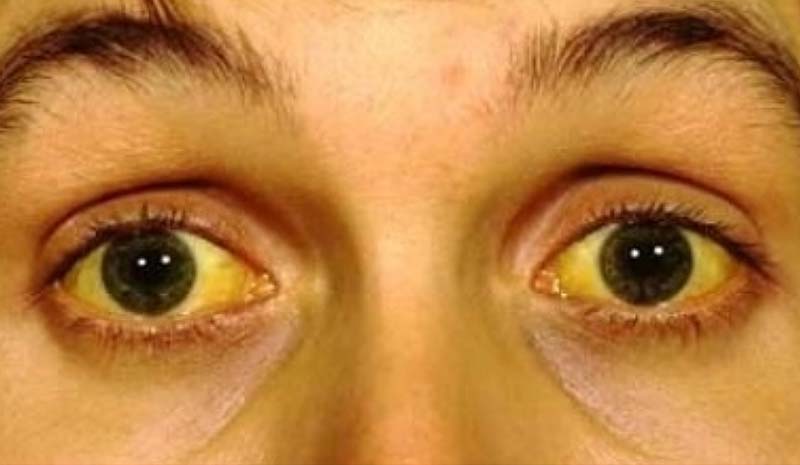 можно ли заболеть желтухой