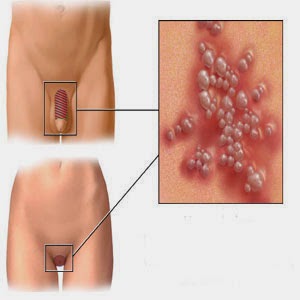 Genital warts: MedlinePlus Medical Encyclopedia