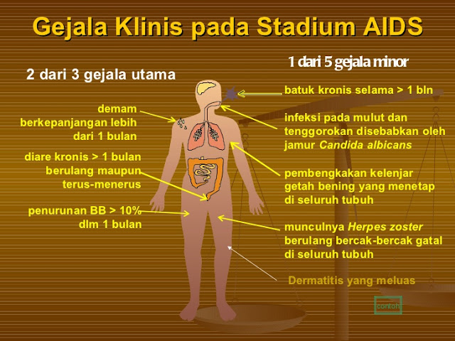 Kenali Gejala Aids Stadium Awal Agar Jangan Sampai Parah