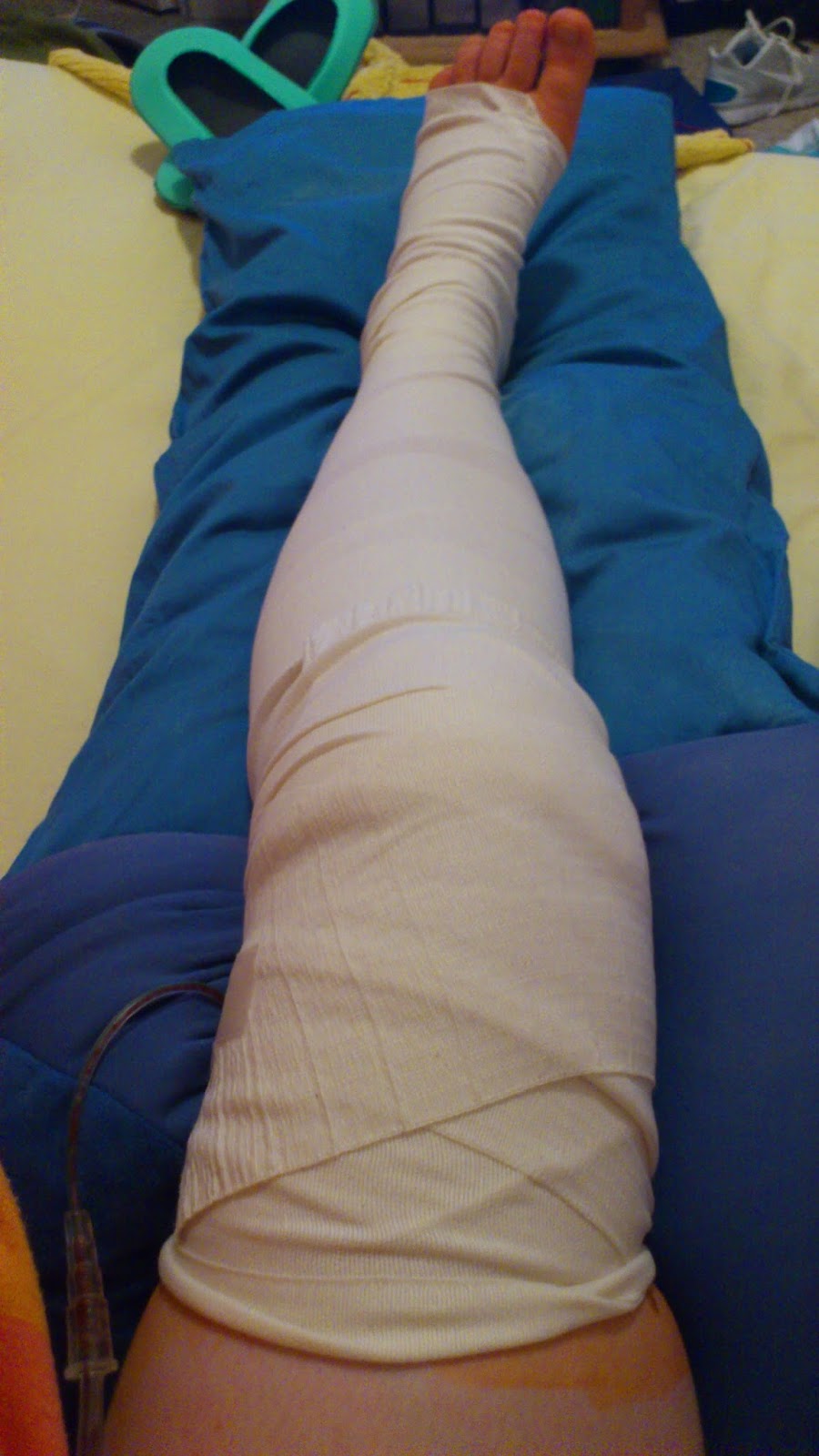 Kniegeschichten Und plötzlich hatte ich Knie... KnieOP die I.