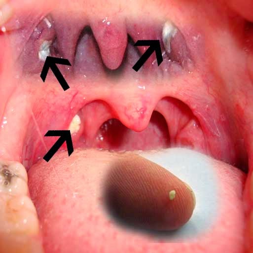 tonsil stones on throat - tonsil stones removal blog
