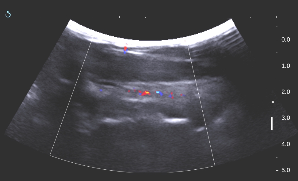 VIETNAMESE MEDIC ULTRASOUND CASE 319 LINGUAL THYROID, Dr PHAN THANH HẢI, MEDIC MEDICAL CENTER