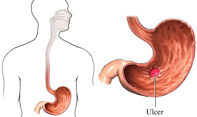 Peptic Ulcer definition, causes and pathogenesis
